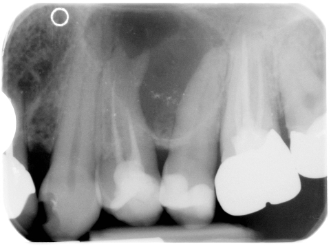 Wird grau zahn wurzelbehandelter Toter Zahn