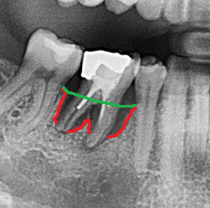 Zahnentfernung wegen zerstörtem Zahnhalteapparat