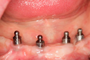 Herausnehmbarer Zahnersatz - Kugelkopfaufbau