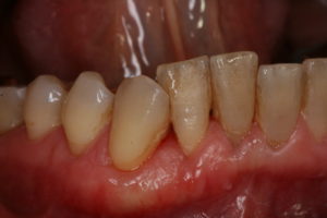Rezessionen/freiliegende Zahnhälse - Zustand nach Zahnfleischverpflanzung