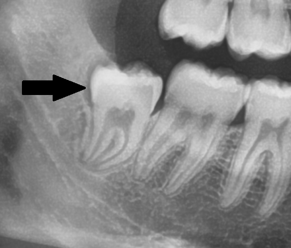Zahnfleisch weisheitszahn drückt gegen Zahnfleisch: Schmerzen