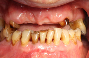 Festsitzender Zahnersatz - Versorgung bei drohender oder vorhandener Zahnlosigkeit