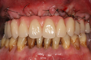 Festsitzender Zahnersatz - Versorgung bei drohender oder vorhandener Zahnlosigkeit