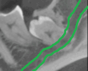 Unklare Lage des Weisheitszahnes und Verlauf des Nervs