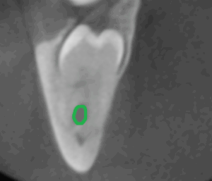 3D-Röntgentechnik (DVT) bei unklare Lage des Weisheitszahnes und Verlauf des Nervs