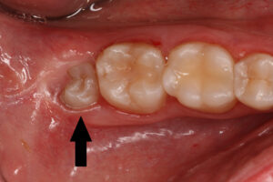 Foto Weisheitszahn mit Platzmangel