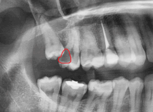 Weisheitszahn mit Kariesbildung an Nachbarzahn