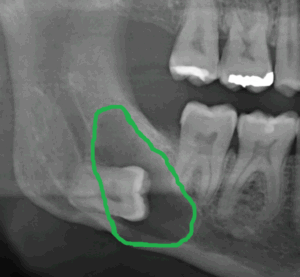 Weisheitszahn mit Zyste