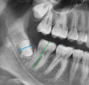 Weisheitszahn verschiebt Zähne