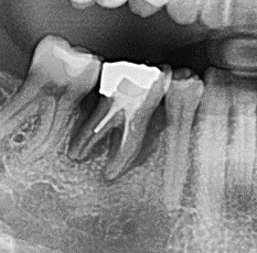 Zahnentfernung wegen zerstörtem Zahnhalteapparat