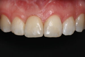 Zustand nach Zahnimplantat