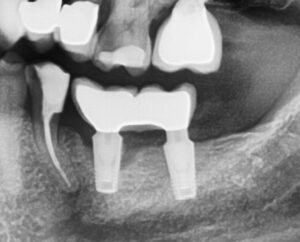 Periimplantitis – Entzündung am vorderen Implantat