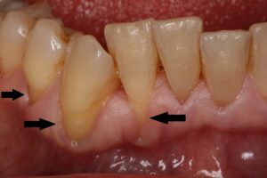 Rezessionen/freiliegende Zahnhälse - Zustand vor Zahnfleischverpflanzung