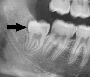 Röntgenbild Weisheitszahn mit Platzmangel