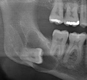 Weisheitszahn mit Zyste