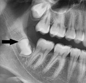 Weisheitszahn verschiebt Zähne