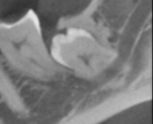 Unklare Lage des Weisheitszahnes und Verlauf des Nervs