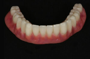 Herausnehmbarer Zahnersatz - Totalprothese