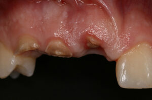 Zahnentfernung wegen Unfall