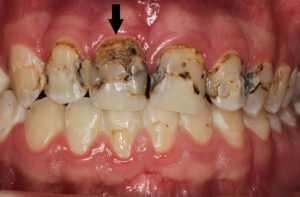 Zahnentfernung wegen Karies