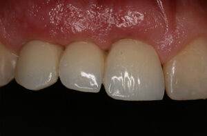 Zustand nach Zahnentfernung mit Implantaten