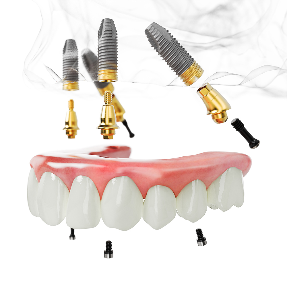 All-on-4 Implantate im Raum Heidelberg, Mannheim, Ludwigshafen, Schwetzingen, Weinheim, Wiesloch, Sinsheim, Speyer, Darmstadt und Bruchsal.